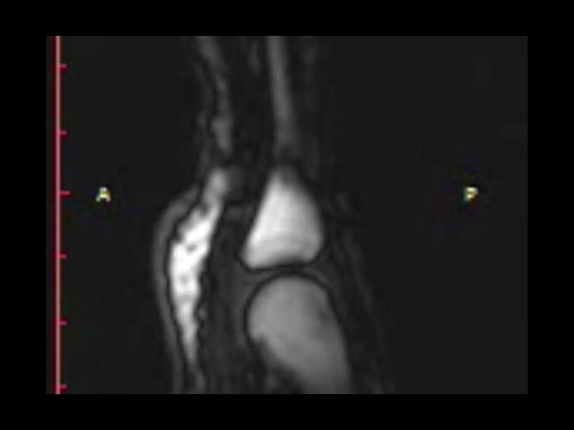 動画１　関節腔内の気泡形成