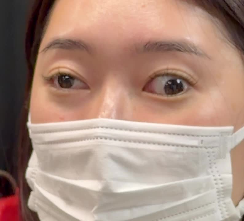 動画1 Bielschowsky徴候ー川添僚也先生・鈴木重明先生...