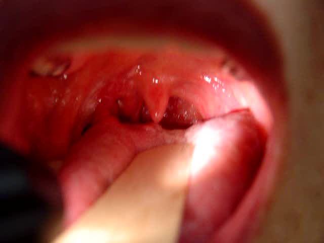 動画1 カーテン徴候ー荒川千晶先生