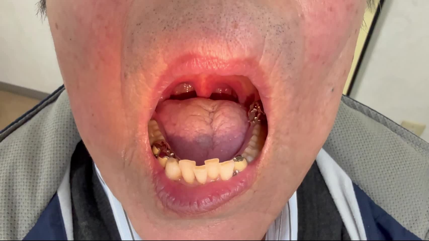 総合診療36巻5号各論９ー動画1：舌の萎縮・線維束性収縮...